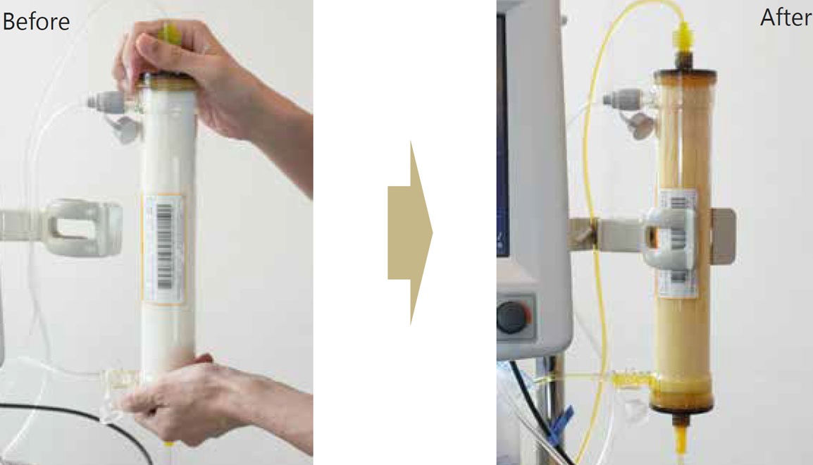 Comparison before and after filter replacement in blood purification therapy