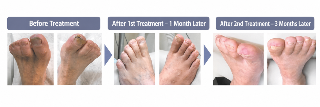 Case example of vascular damage associated with diabetes: progress before treatment, after the first administration, and after the second administration