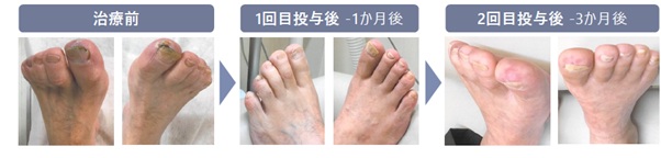 糖尿病に伴う血管障害の症例:治療前・1回目投与後・2回目投与後の経過